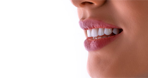 Blanqueamiento dental